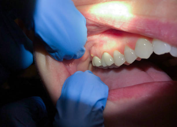 Best Tooth Infection Emergency Dentist  in Stiles, PA